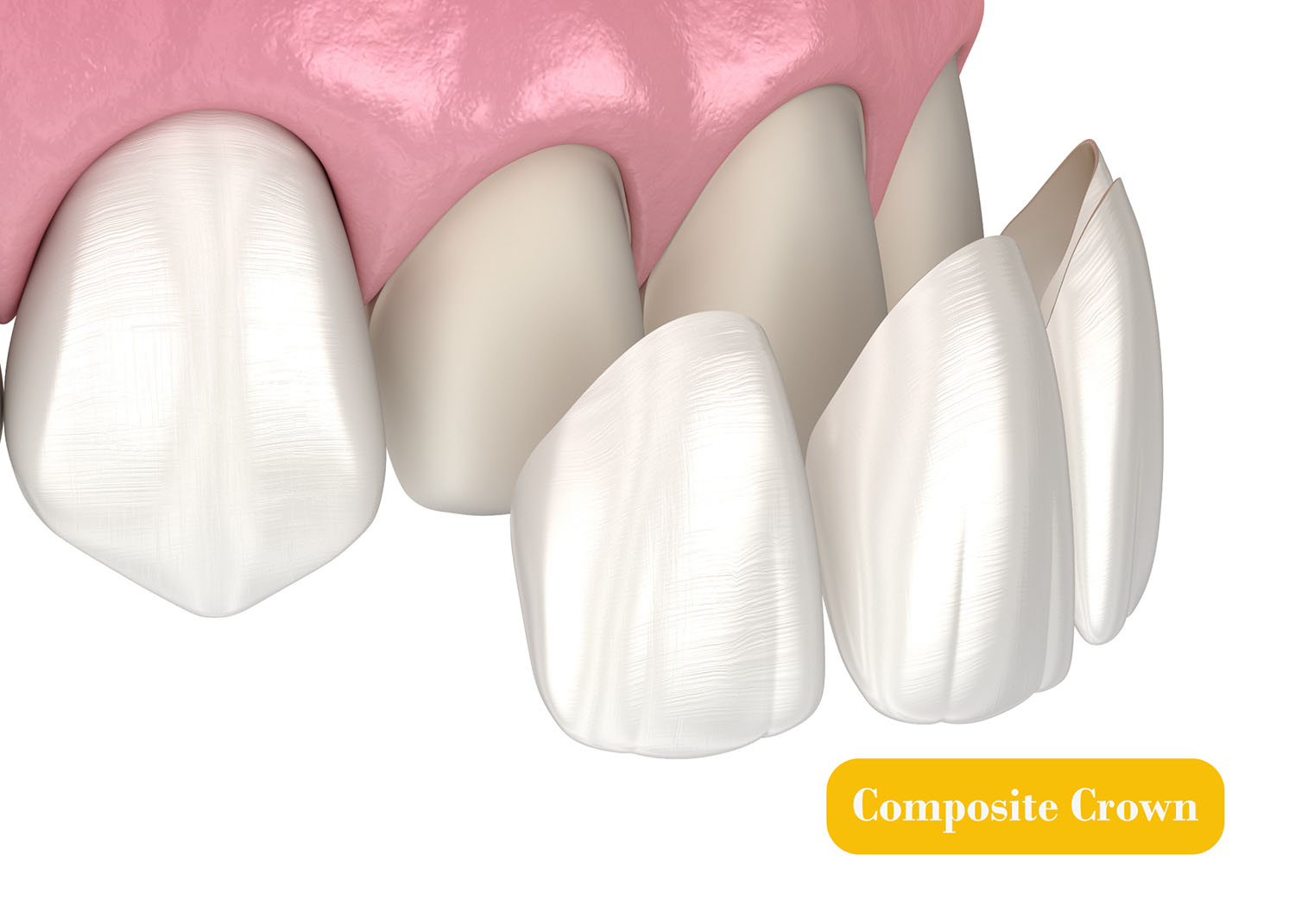 Dental Crowns Lighthouse Dental Centre Langley Dentist